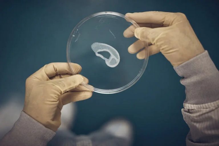 A világon elsőként kapott a saját sejtjeiből 3D-nyomtatott fület egy páciens
