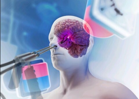 Robotcsápokkal végzett agyműtétet terveznek brit kutatók